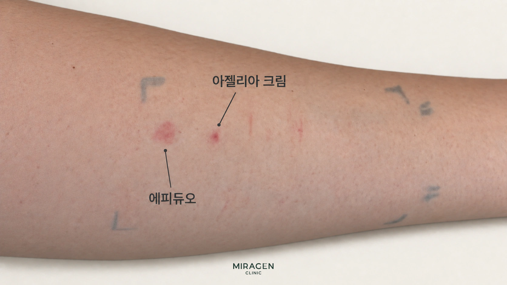 여드름 연고인 아젤리아크림과 에피듀오겔의 첩포검사에서 팔에 나타난 붉은 피부 반응을 표시한 편집 이미지